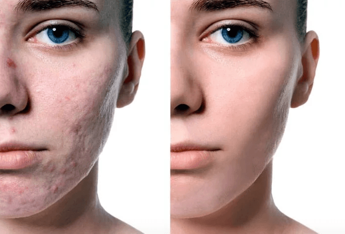 Limpieza facial profunda